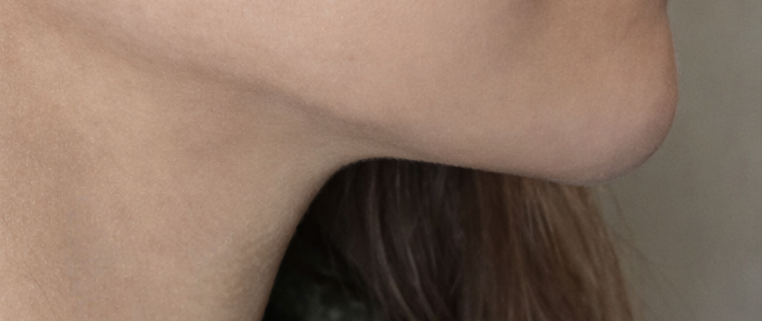 After procedure image