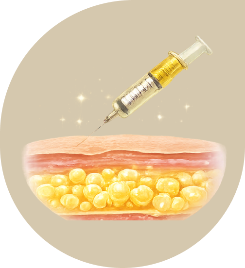 Injection lipolysis stage image 1